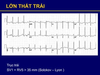 LỚN THẤT TRÁI
Trục trái
SV1 + RV5 > 35 mm (Solokov – Lyon )
 