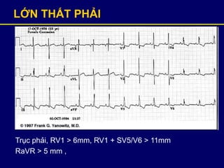 LỚN THẤT PHẢI
Trục phải, RV1 > 6mm, RV1 + SV5/V6 > 11mm
RaVR > 5 mm ,
 