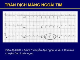 TRÀN DỊCH MÀNG NGOÀI TIM
Biên độ QRS < 5mm ở chuyển đạo ngoại vi và < 10 mm ở
chuyển đạo trước ngực
 
