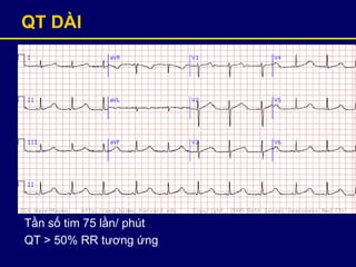 QT DÀI
Tần số tim 75 lần/ phút
QT > 50% RR tương ứng
 