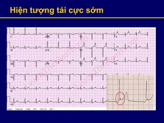 Hiện tƣợng tái cực sớm
 