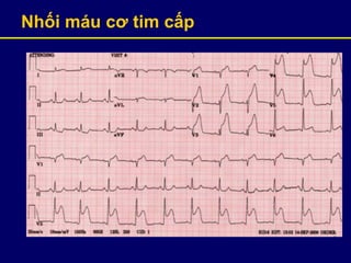 Nhối máu cơ tim cấp
 
