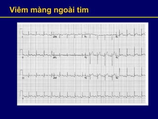 Viêm màng ngoài tim
 