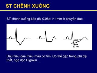 ST CHÊNH XUỐNG
ST chênh xuống kéo dài 0,08s: > 1mm ở chuyển đạo.
Dấu hiệu của thiếu máu cơ tim. Có thể gặp trong phì đại
thất, ngộ độc Digoxin…
 