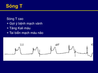 Sóng T
Sóng T cao
+ Gợi ý bệnh mạch vành
+ Tăng Kali máu
+ Tai biến mạch máu não
 