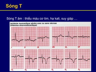 Sóng T
Sóng T âm : thiếu máu cơ tim, hạ kali, suy giáp …
 