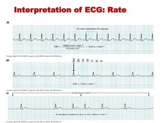 Interpretation of ECG: Rate
 