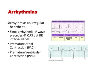 Arrhythmias
Arrhythmia: an irregular
heartbeat.
• Sinus arrhythmia- P wave
precedes @ QRS but RR
interval varies.
• Premature Atrial
Contraction (PAC)
• Premature Ventricular
Contraction (PVC)
 