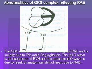 5 Example Complex Rae Ecg criteria of chamber enlargement | PPT