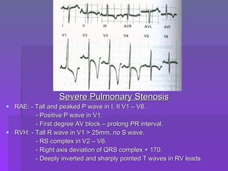 Peaked R Complex Ecg criteria of chamber enlargement | PPT
