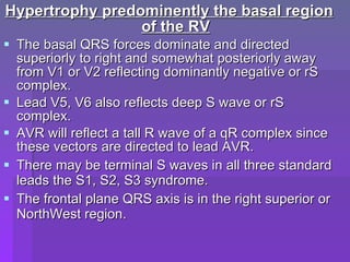 Avr Terminal R Wave Ecg criteria of chamber enlargement | PPT
