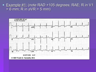 Rad Ecg Example Ecg criteria of chamber enlargement | PPT