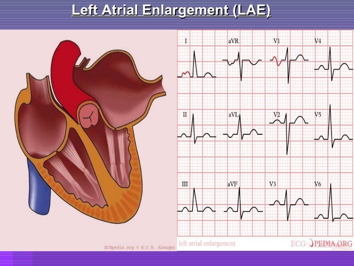 Left Atrial Enlargement Ecg Criteria Sharedoc