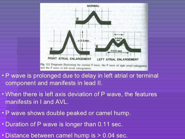 enlargement criteria atrial