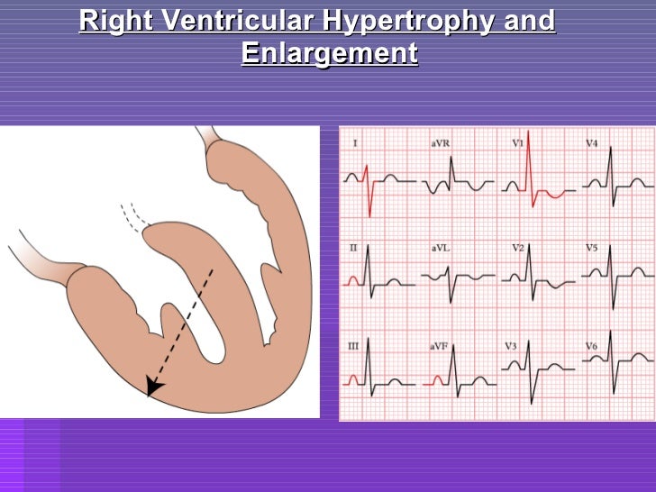 Ecg criteria of chamber enlargement