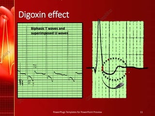 Digoxin effect
PowerPlugs Templates for PowerPoint Preview 11
Biphasic T waves and
superimposed U waves
 
