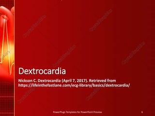 Dextrocardia
Nickson C. Dextrocardia (April 7, 2017). Retrieved from
https://lifeinthefastlane.com/ecg-library/basics/dextrocardia/
PowerPlugs Templates for PowerPoint Preview 6
 