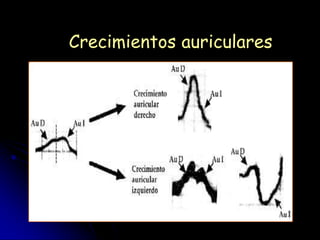 Crecimientos auriculares
 