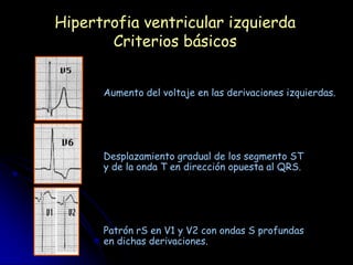 Hipertrofia ventricular izquierda
       Criterios básicos


      Aumento del voltaje en las derivaciones izquierdas.




      Desplazamiento gradual de los segmento ST
      y de la onda T en dirección opuesta al QRS.




      Patrón rS en V1 y V2 con ondas S profundas
      en dichas derivaciones.
 