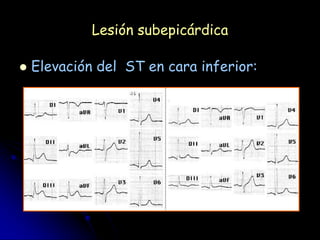 Lesión subepicárdica

   Elevación del ST en cara inferior:
 