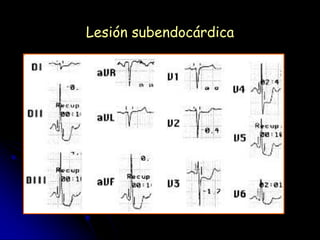 Lesión subendocárdica
 