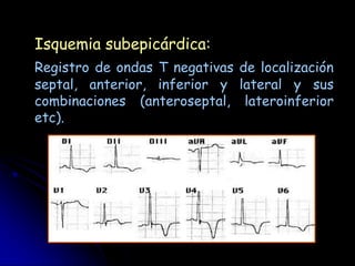 Isquemia subepicárdica:
Registro de ondas T negativas de localización
septal, anterior, inferior y lateral y sus
combinaciones (anteroseptal, lateroinferior
etc).
 