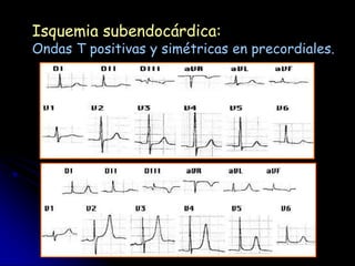 Isquemia subendocárdica:
Ondas T positivas y simétricas en precordiales.
    22-10-97 (mismo paciente que en ejemplo anterior
 