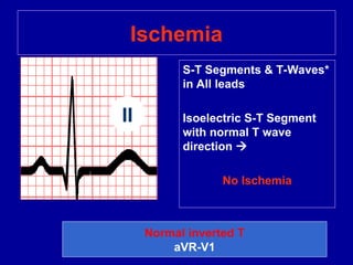 ECG(DIAGNOSTIC TOOLS) learn basics .ppt