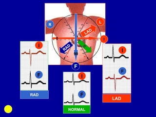 Rad Ecg Example ECG(DIAGNOSTIC TOOLS) learn basics .ppt