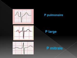 P pulmonaire

P large

P mitrale

 