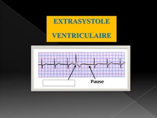 EXTRASYSTOLE
VENTRICULAIRE

 