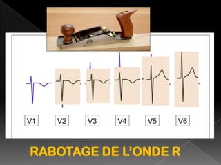 RABOTAGE DE L’ONDE R

 