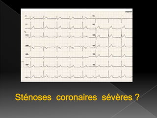 Sténoses coronaires sévères ?

 