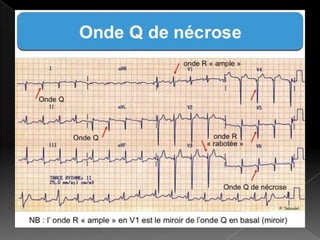 Ecg La Lecture Pratique Pour Les Debutants Dr Mahmoudi F