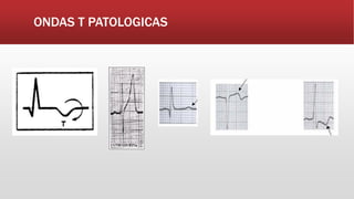 ONDAS T PATOLOGICAS
 