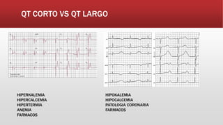QT CORTO VS QT LARGO
HIPERKALEMIA
HIPERCALCEMIA
HIPERTERMIA
ANEMIA
FARMACOS
HIPOKALEMIA
HIPOCALCEMIA
PATOLOGIA CORONARIA
FARMACOS
 