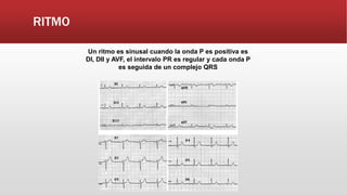 RITMO
Un ritmo es sinusal cuando la onda P es positiva es
DI, DII y AVF, el intervalo PR es regular y cada onda P
es seguida de un complejo QRS
 