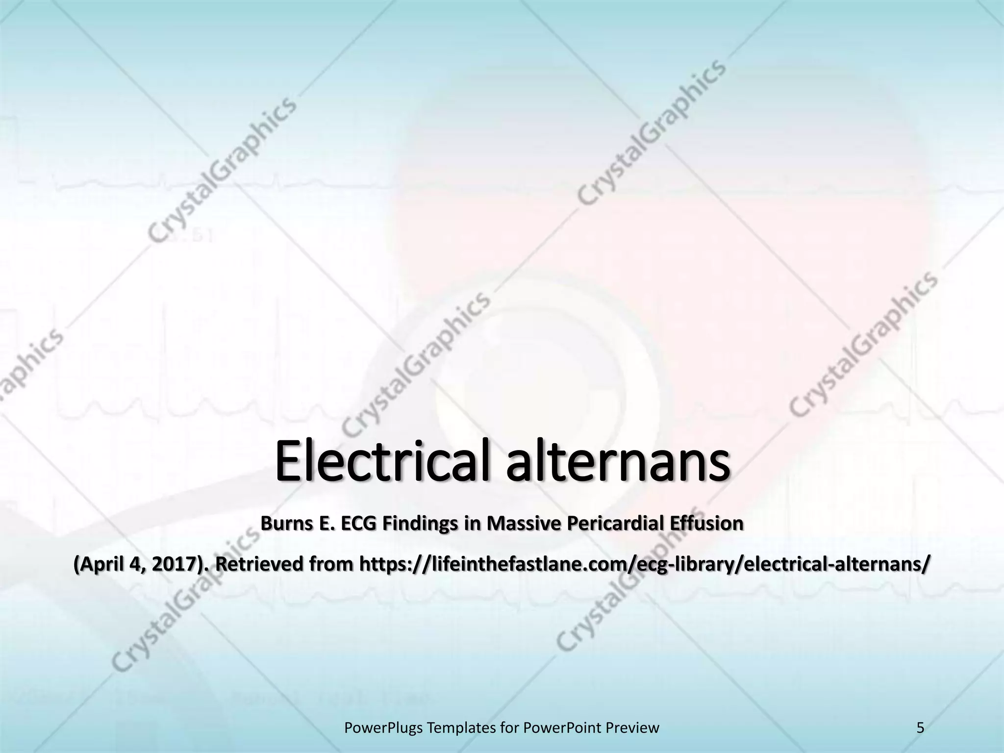 Electrical alternans
Burns E. ECG Findings in Massive Pericardial Effusion
(April 4, 2017). Retrieved from https://lifeinthefastlane.com/ecg-library/electrical-alternans/
PowerPlugs Templates for PowerPoint Preview 5
 