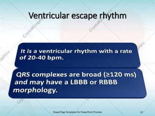 Ventricular escape rhythm
PowerPlugs Templates for PowerPoint Preview 12
 