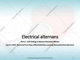 Electrical alternans
Burns E. ECG Findings in Massive Pericardial Effusion
(April 4, 2017). Retrieved from https://lifeinthefastlane.com/ecg-library/electrical-alternans/
PowerPlugs Templates for PowerPoint Preview 5
 