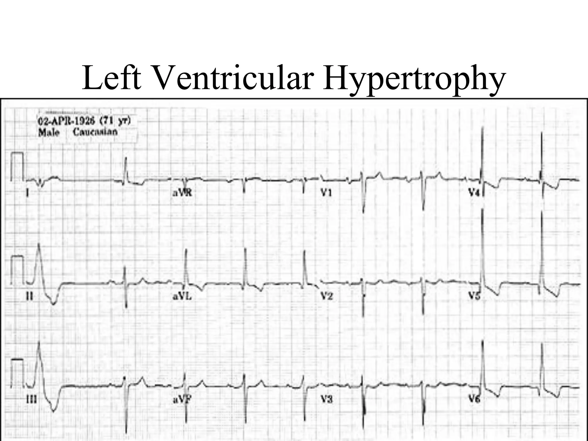 Left Ventricular Hypertrophy
 