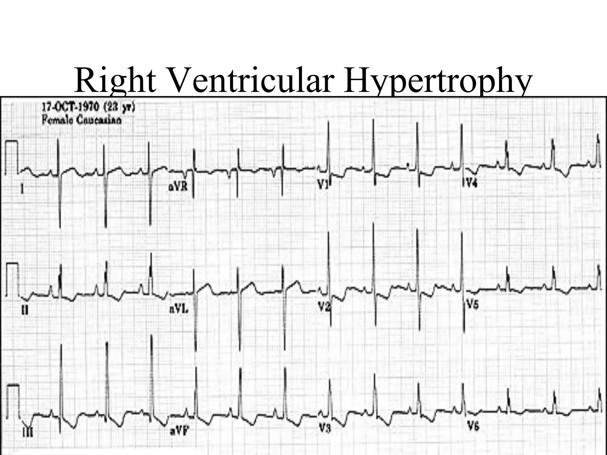Right Ventricular Hypertrophy
 