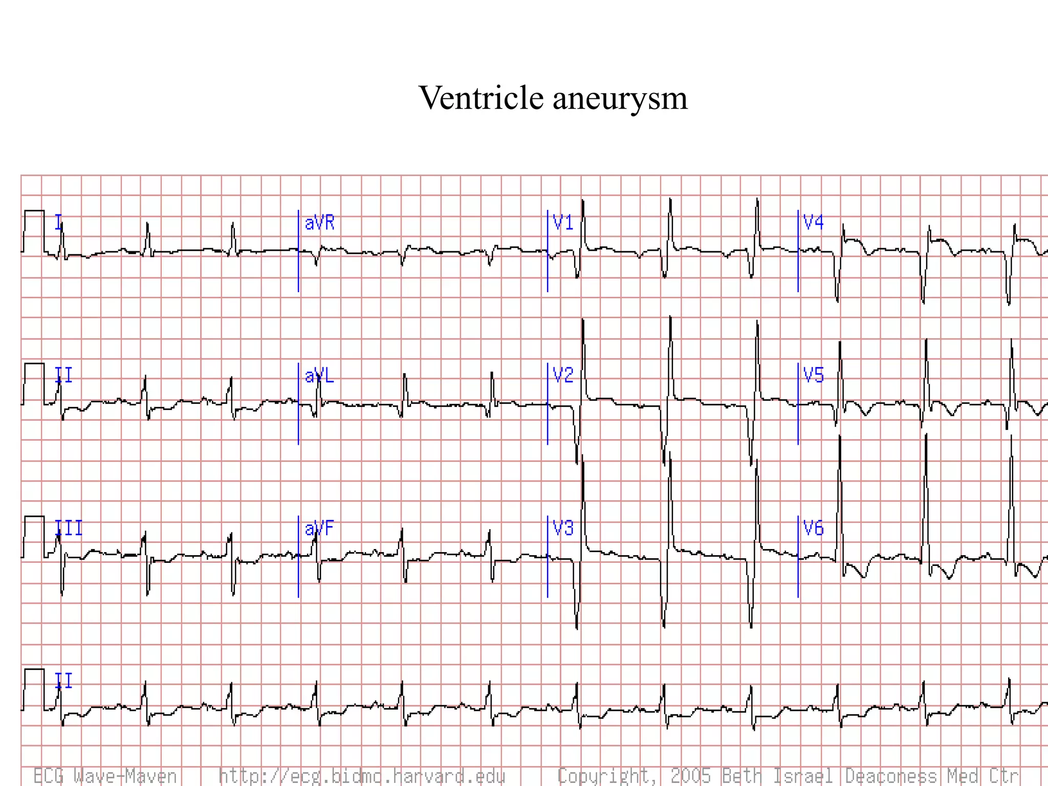 Ventricle aneurysm
 