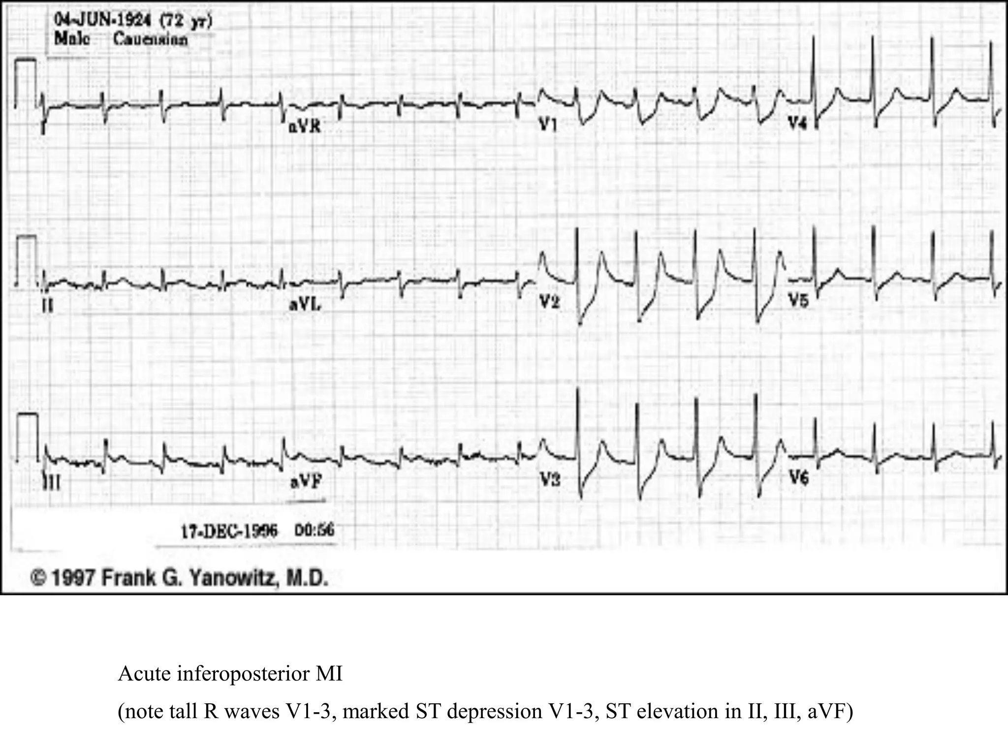 Acute inferoposterior MI
(note tall R waves V1-3, marked ST depression V1-3, ST elevation in II, III, aVF)
 