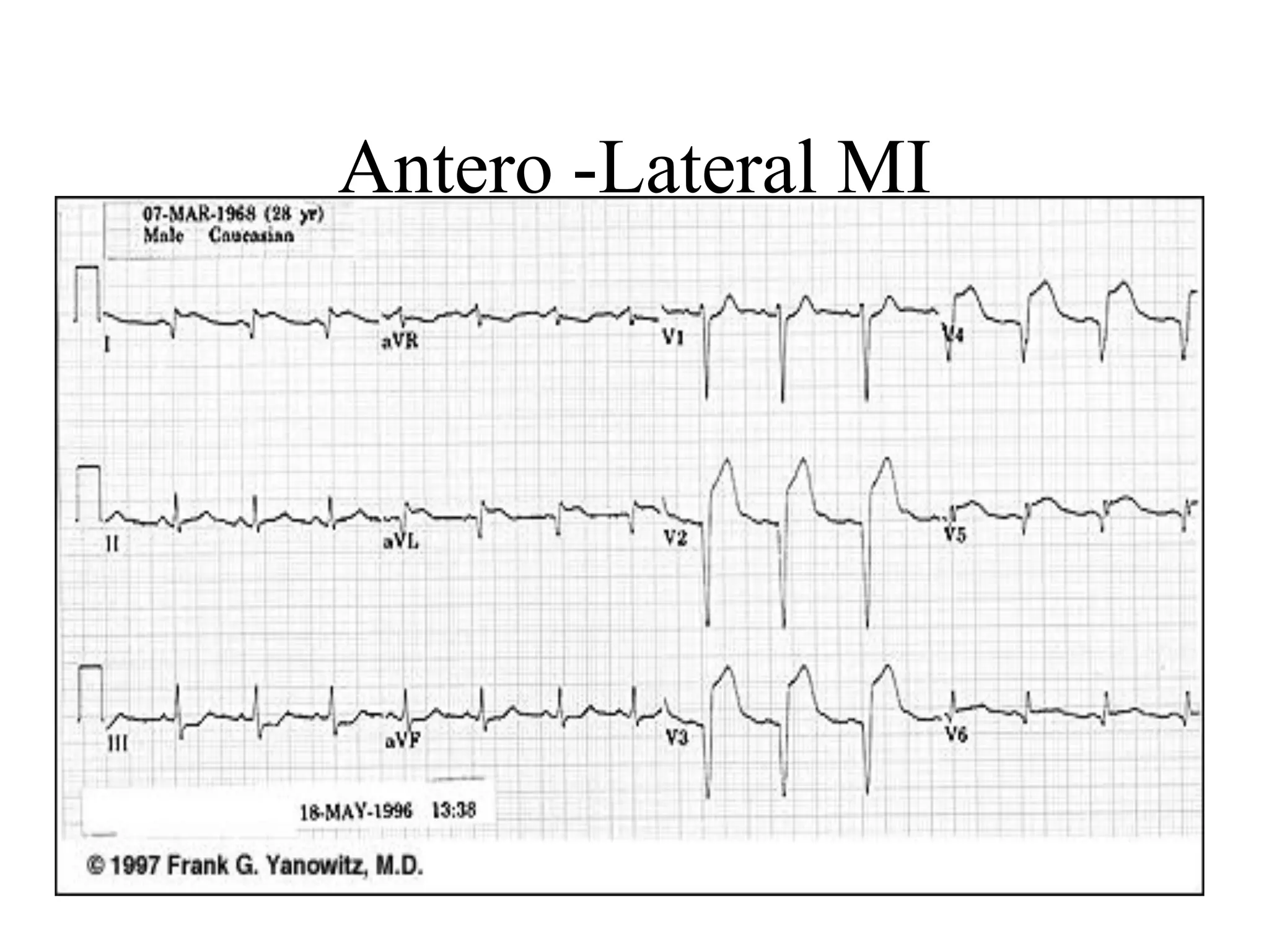 Antero -Lateral MI
 