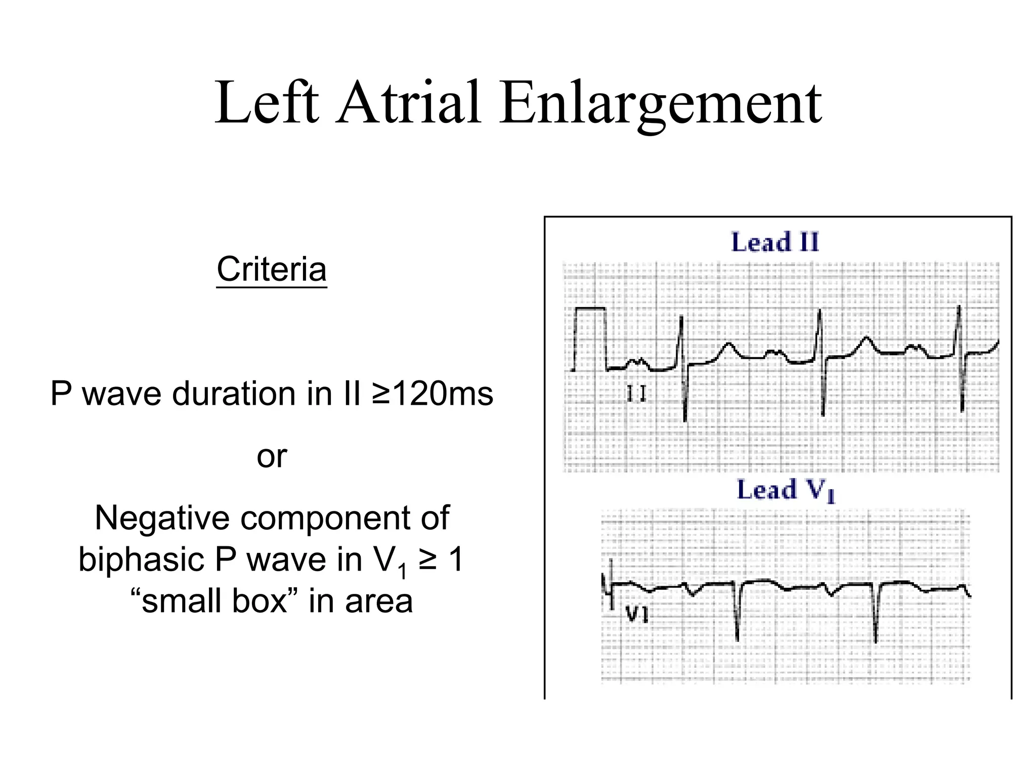 Left Atrial Enlargement
Criteria
P wave duration in II ≥120ms
or
Negative component of
biphasic P wave in V1 ≥ 1
“small box” in area
 