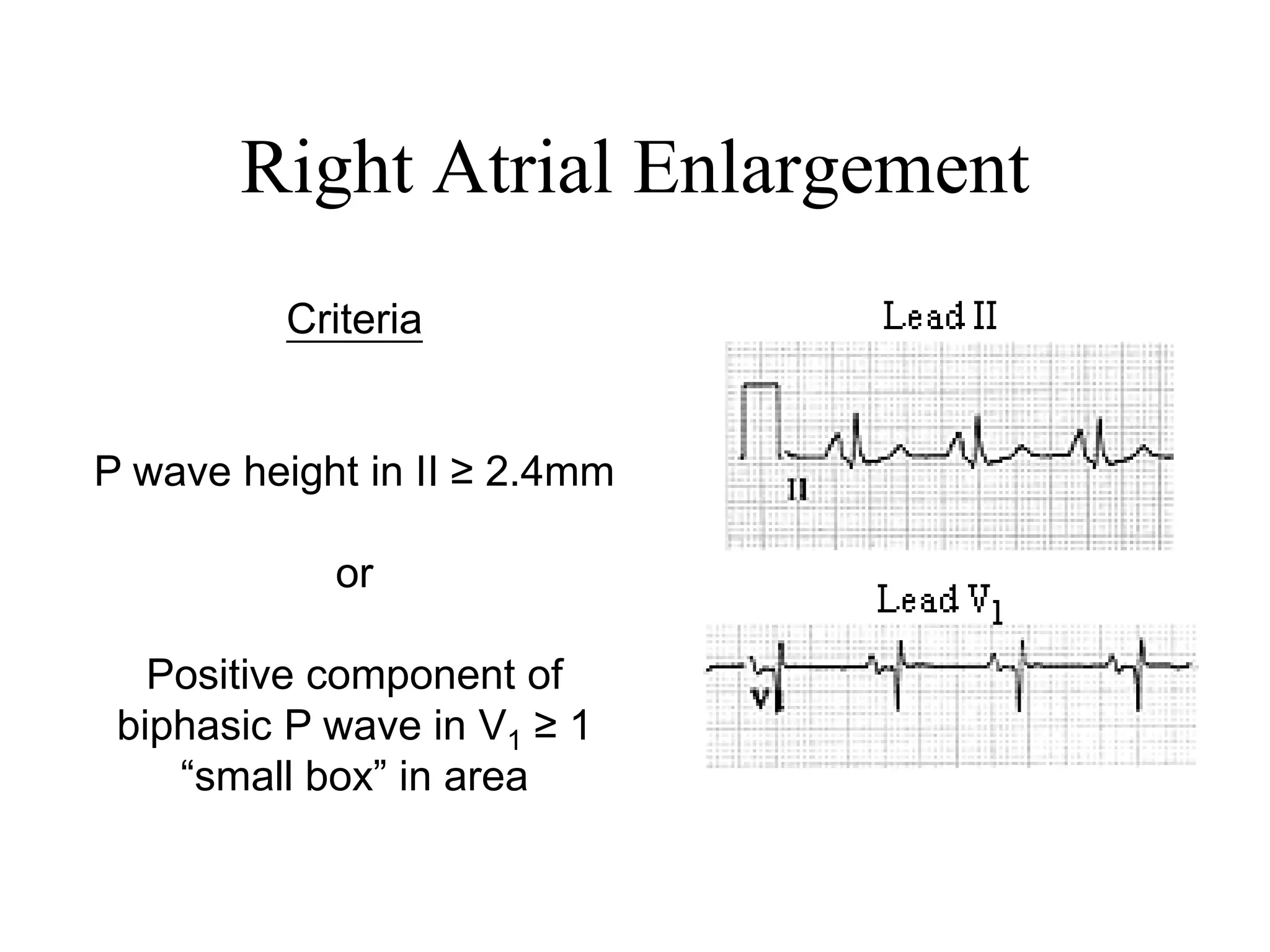 Right Atrial Enlargement
Criteria
P wave height in II ≥ 2.4mm
or
Positive component of
biphasic P wave in V1 ≥ 1
“small box” in area
 
