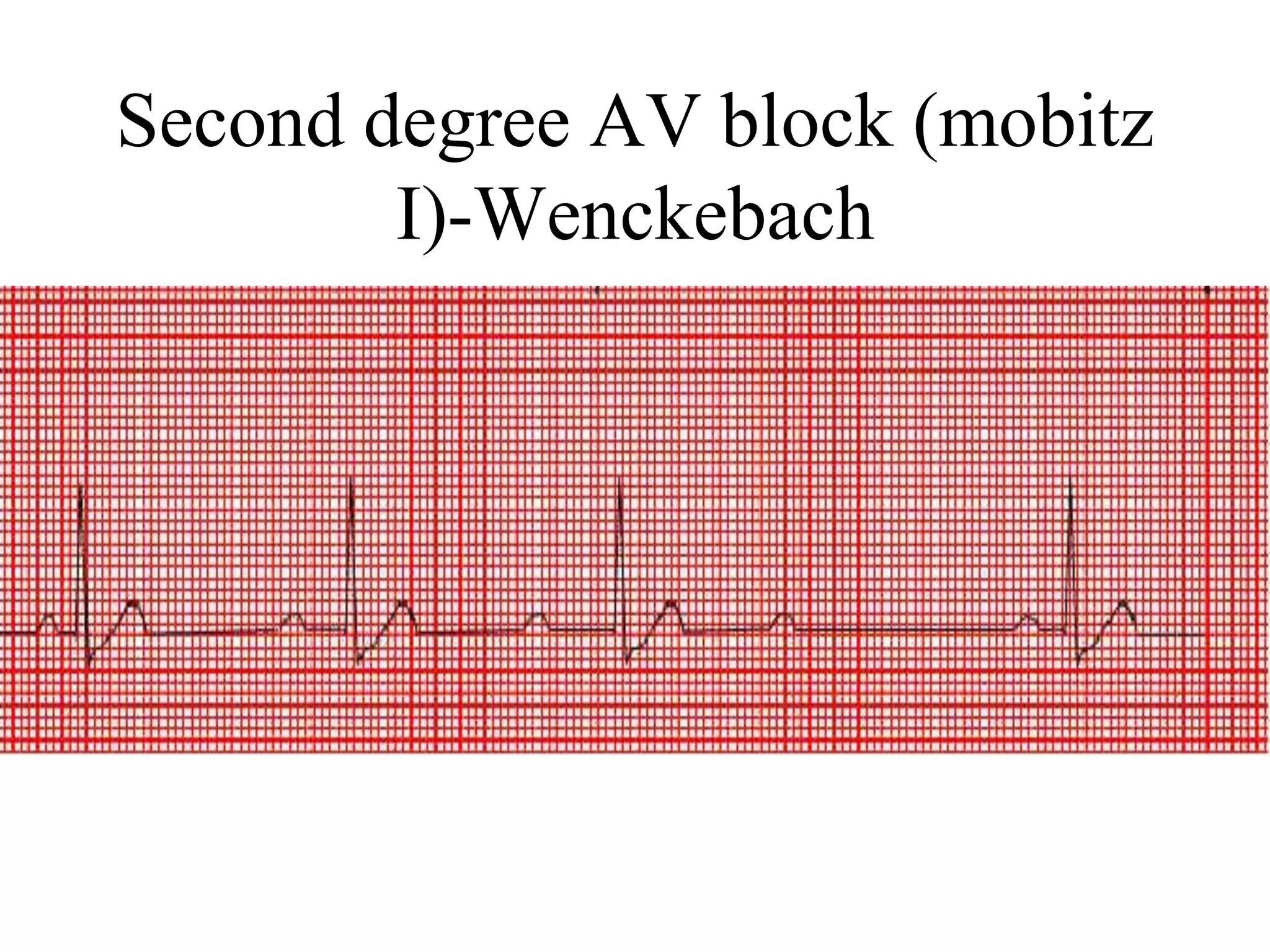 Second degree AV block (mobitz
I)-Wenckebach
 