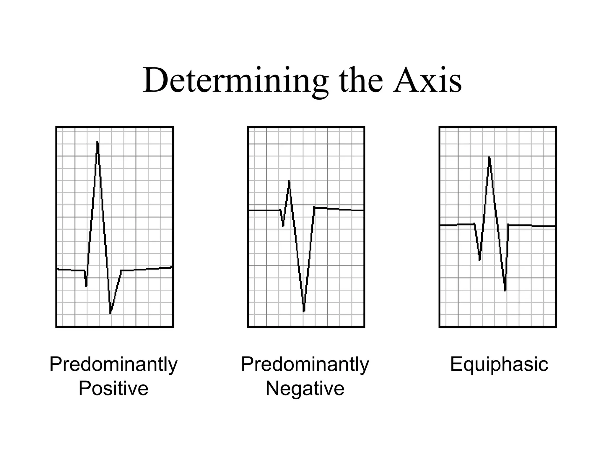 Determining the Axis
Predominantly
Positive
Predominantly
Negative
Equiphasic
 