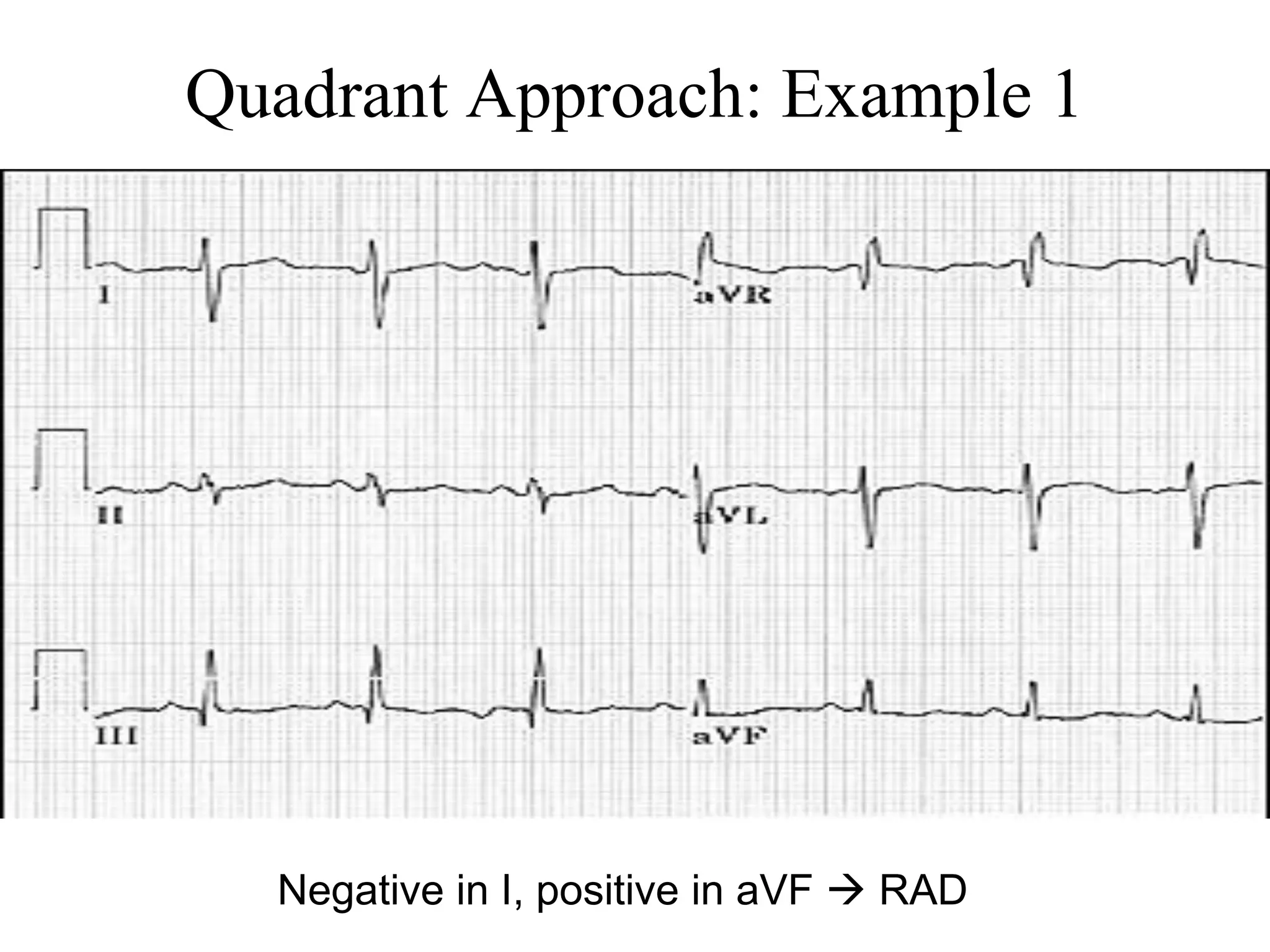 Quadrant Approach: Example 1
Negative in I, positive in aVF  RAD
 